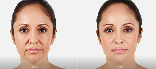 juvederm1