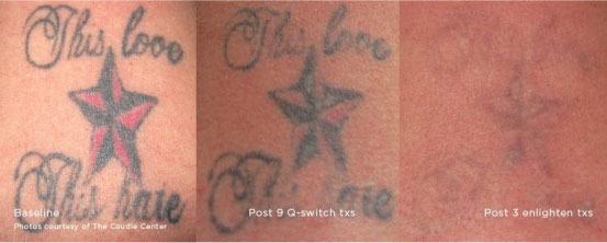 Enlighten Laser Tattoo Removal  Tareen Dermatology  Roseville Minnesota