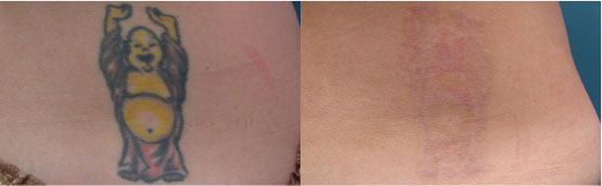 tattoo_removal_2