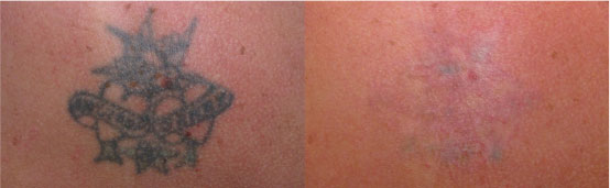 Enlighten Laser Tattoo Removal  Medical Aesthetics of Suwanee