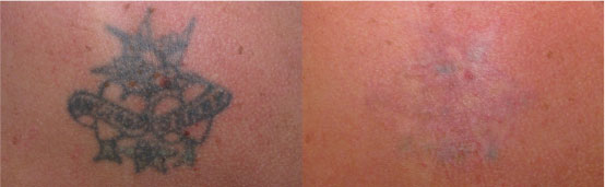 tattoo_removal_3
