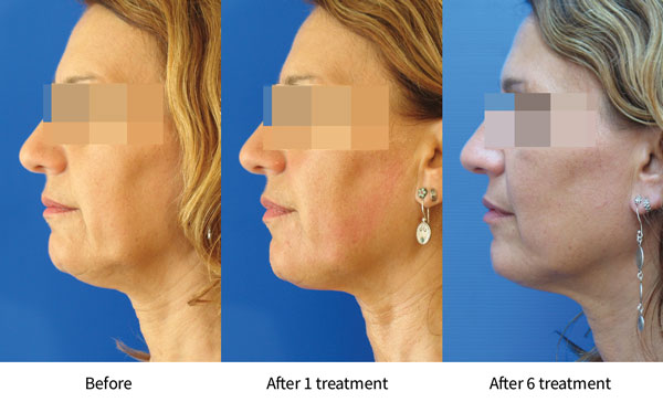 TriPollar® Skin Tightening Treatment in Midtown Toronto