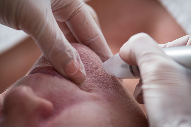 men-macrodermabrasion