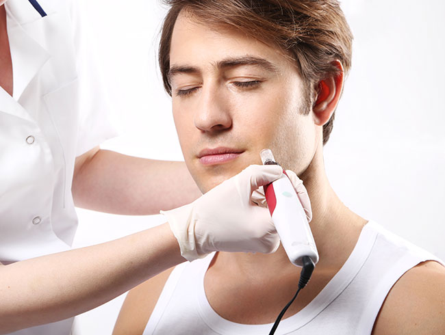 men-microdermabrasion1