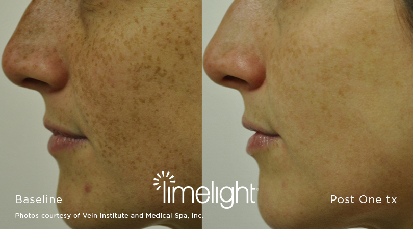 xeo_Limelight_3