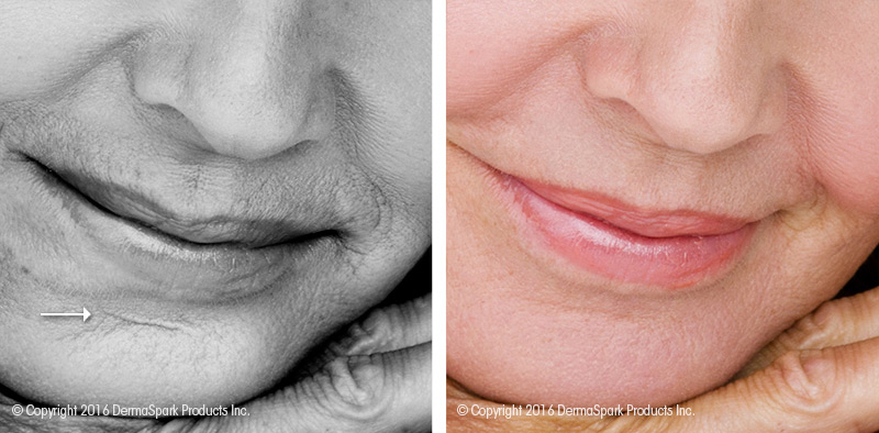 Dermastamp Microneedling Before and After