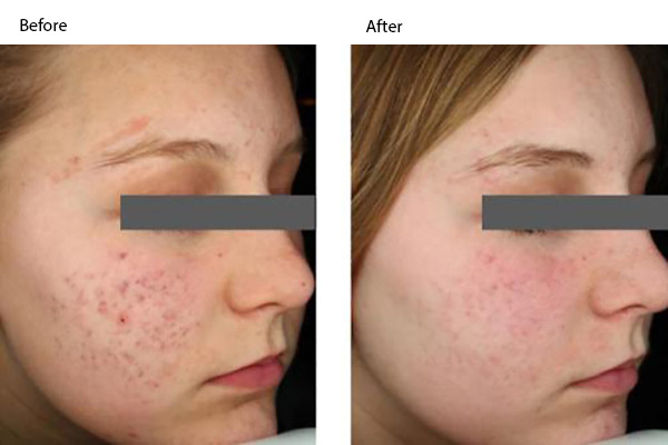 Laser Genesis for Acne