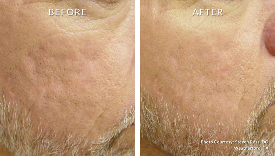 Laser Genesis for Texture and Rosacea