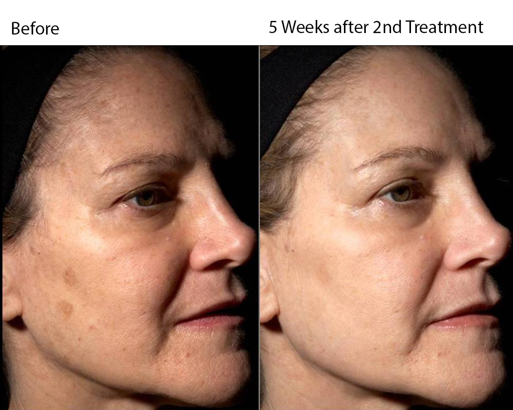 Pearl Skin Resurfacing Before and After