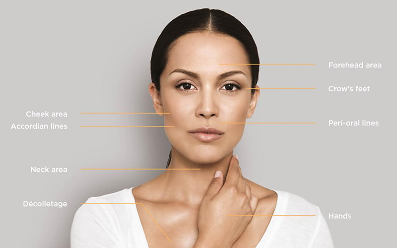 Restylane-Refresh Restylane Refresh
