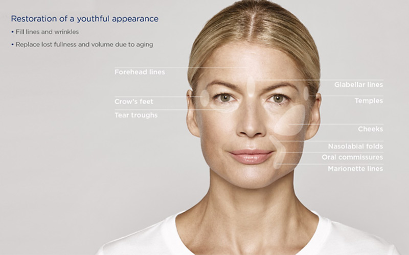 Restylane-Restore Restylane Restore