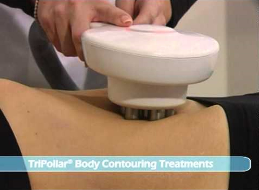 Tripollar-Body-Contouring Tripollar Body Contouring