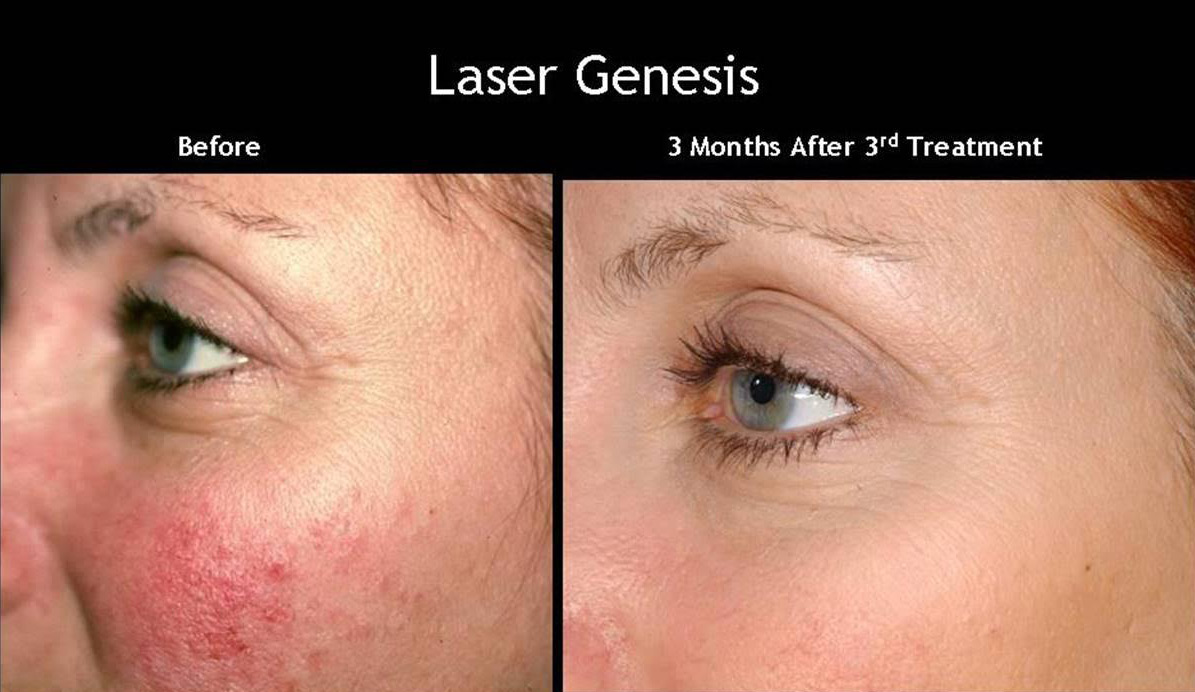 Laser Genesis Before and After