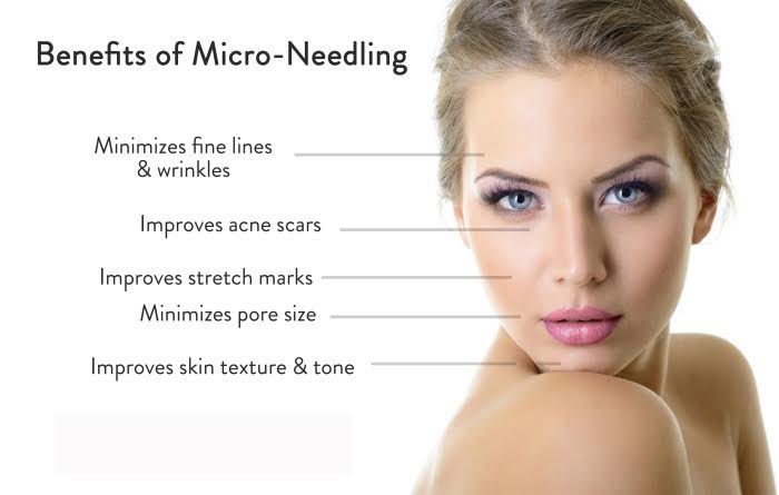 microneedling Benefits of Micro-Needling