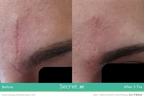 Secret RF Before and After - Scar