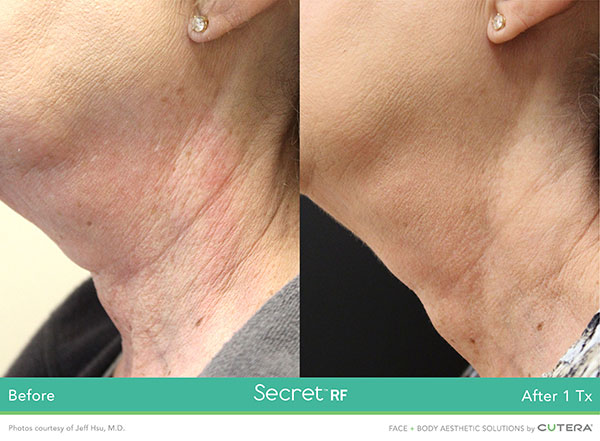 Secret RF Before and After - Neck