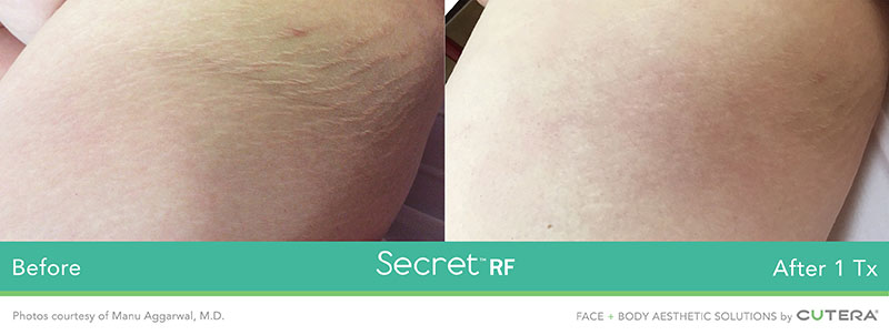 Secret RF Before and After - Face and Body