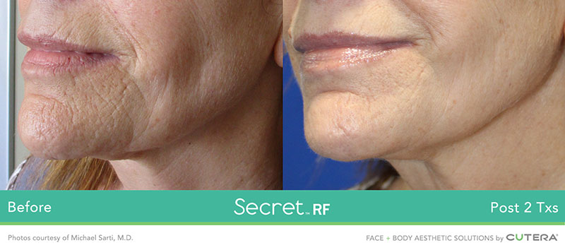 Secret RF Before and After - Chin and Neck