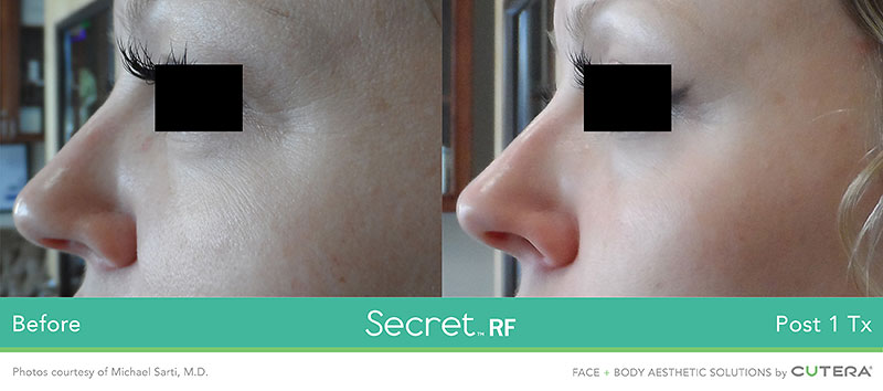 Secret RF Before and After - Eyes