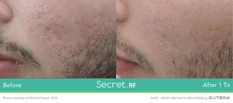 Secret RF Before and After After 1 Tx - For Men