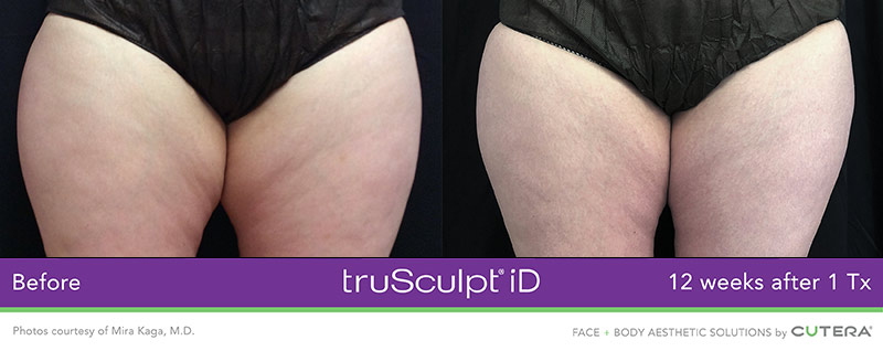 truSculpt iD Before and After - 12 Weeks