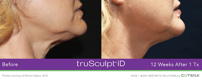 truSculpt iD Before and After - 12 Weeks after 1 Tx