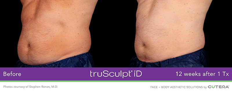 truSculpt iD Before and After - 12 Weeks after 1 Tx