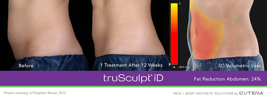 truSculpt iD Before and After - Fat Reduction Abdomen