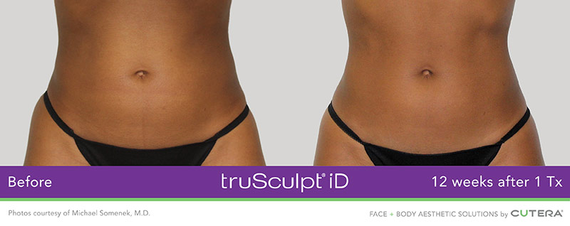 truSculpt iD Before and After - 12 Weeks after 1 Tx