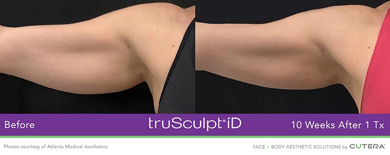 truSculpt iD Before and After - 10 weeks
