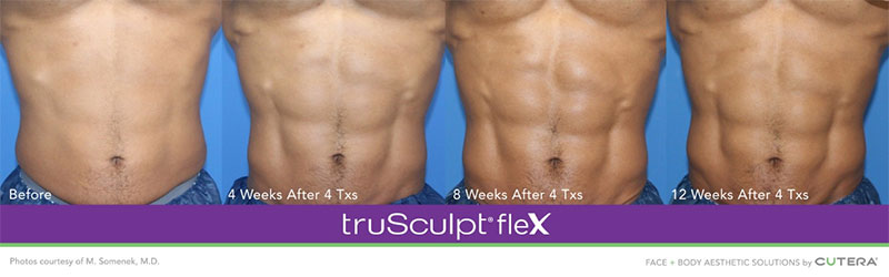 truSculpt®flex 12 Weeks After 4 Txs