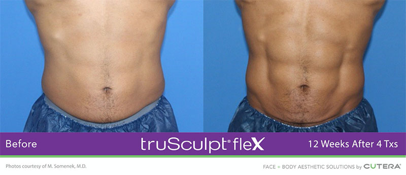 truSculpt®flex 12 Weeks After 4 Txs