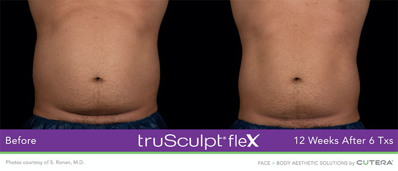 truSculpt®flex 12 Weeks After 6 Txs