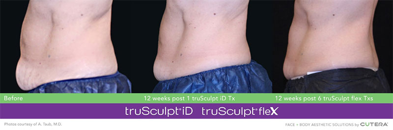 truSculpt®flex 12 Weeks Afte 6 Txs