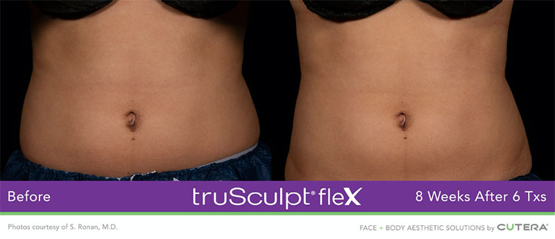 truSculpt®flex 8 weeks after 6 Txs