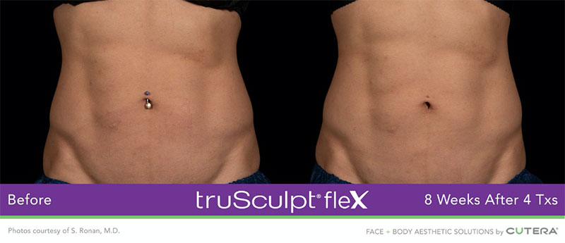 truSculpt®flex 8 weeks after 4 Txs