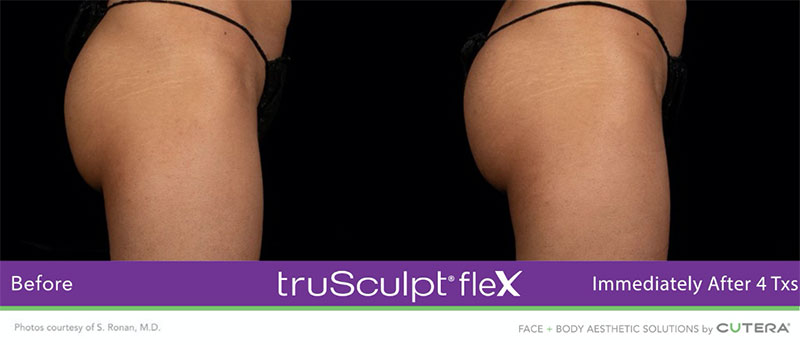 truSculpt®flex Immediately After 4 Txs