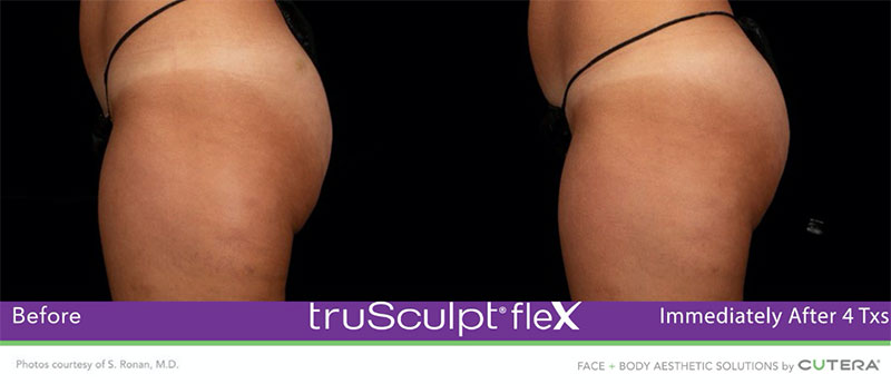 truSculpt®flex Immediately After 4 Txs